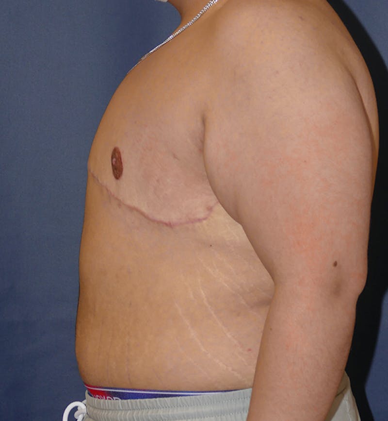 Masculinizing Surgery Before & After Gallery - Patient 395591 - Image 4