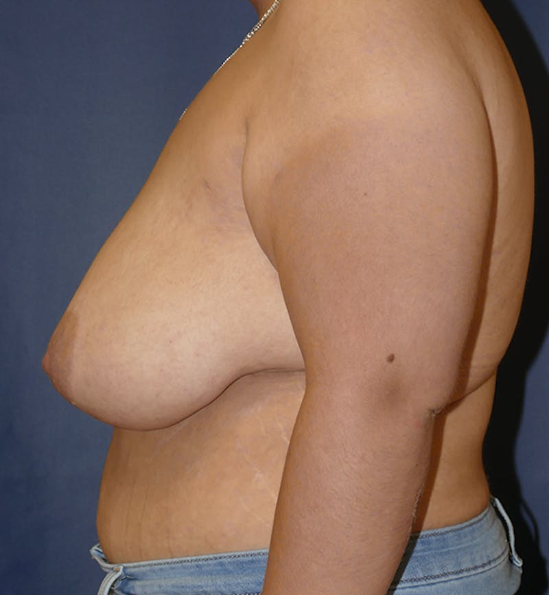 Masculinizing Surgery Before & After Gallery - Patient 395591 - Image 3