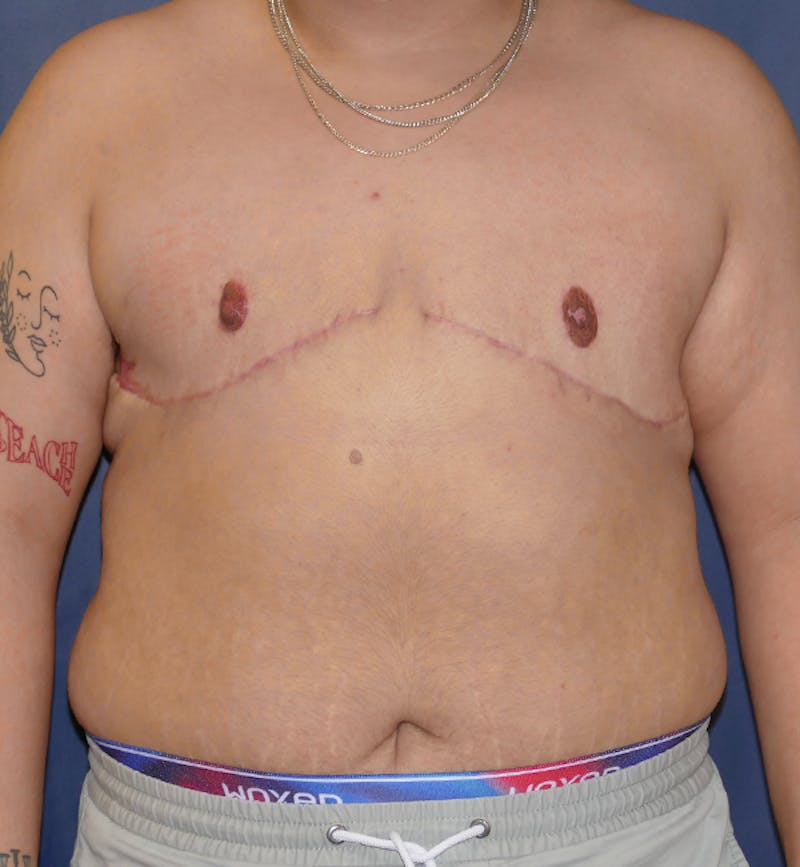 Masculinizing Surgery Before & After Gallery - Patient 395591 - Image 2