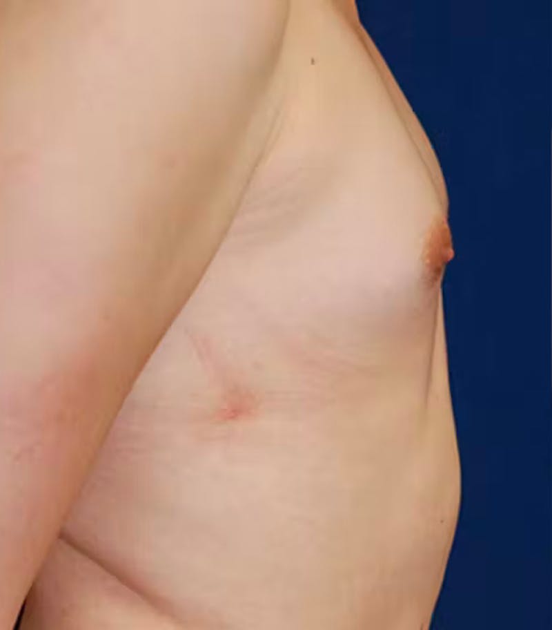 Feminizing Surgery Before & After Gallery - Patient 221275 - Image 3