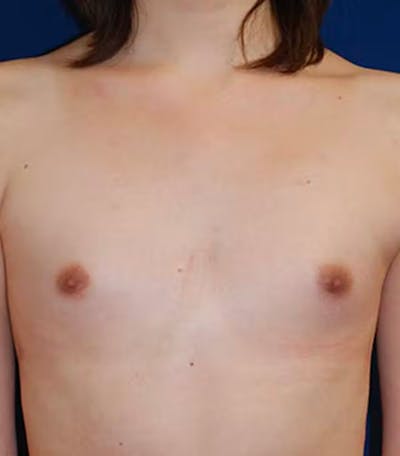 Feminizing Surgery Before & After Gallery - Patient 221275 - Image 1