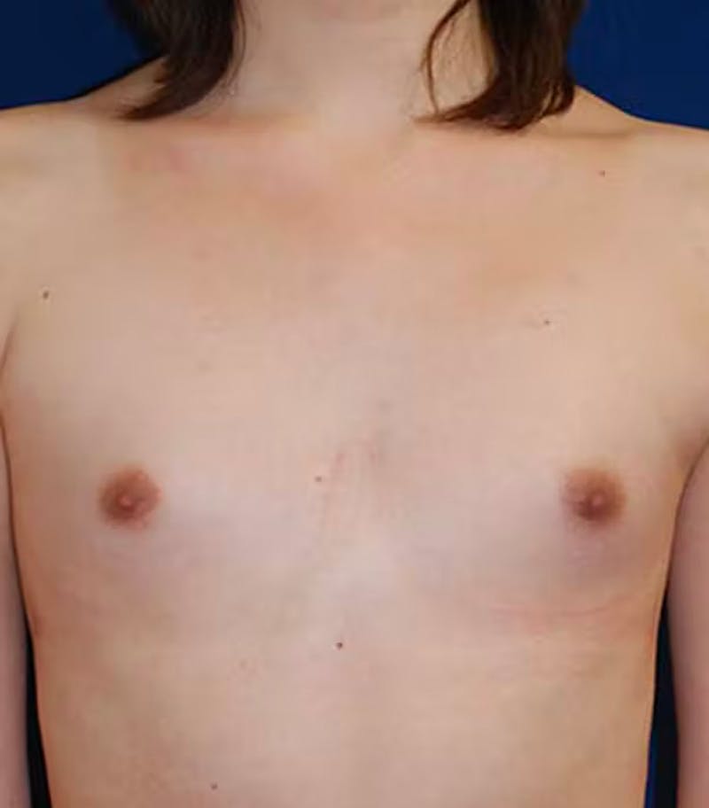 Feminizing Surgery Before & After Gallery - Patient 221275 - Image 1