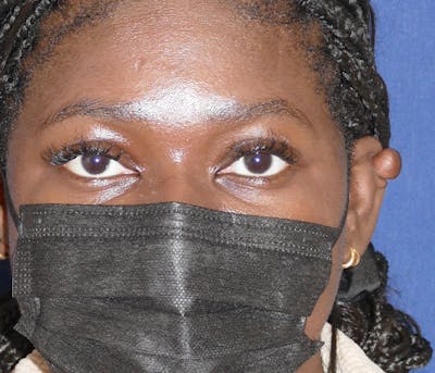 Miscellaneous Before & After Gallery - Patient 320329 - Image 1