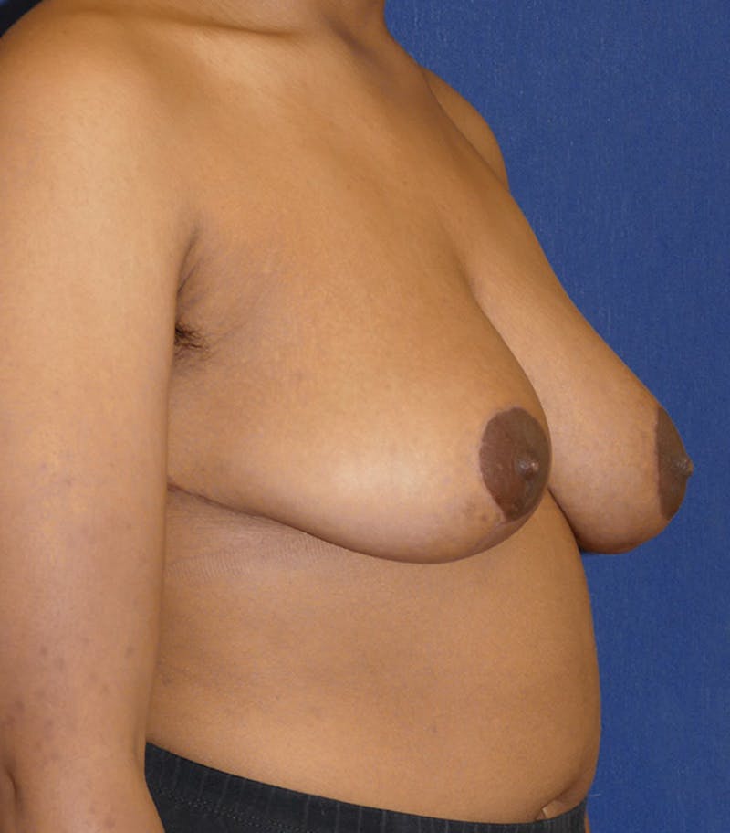 Breast Reduction Before & After Gallery - Patient 681288 - Image 8