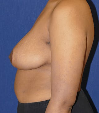 Breast Reduction Before & After Gallery - Patient 681288 - Image 4