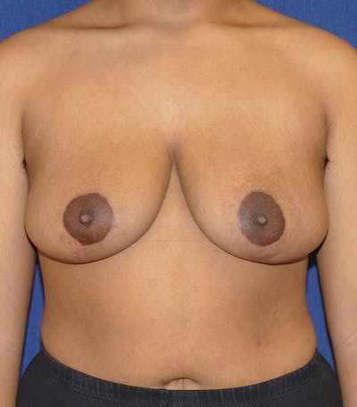 Breast Reduction Before & After Gallery - Patient 681288 - Image 2