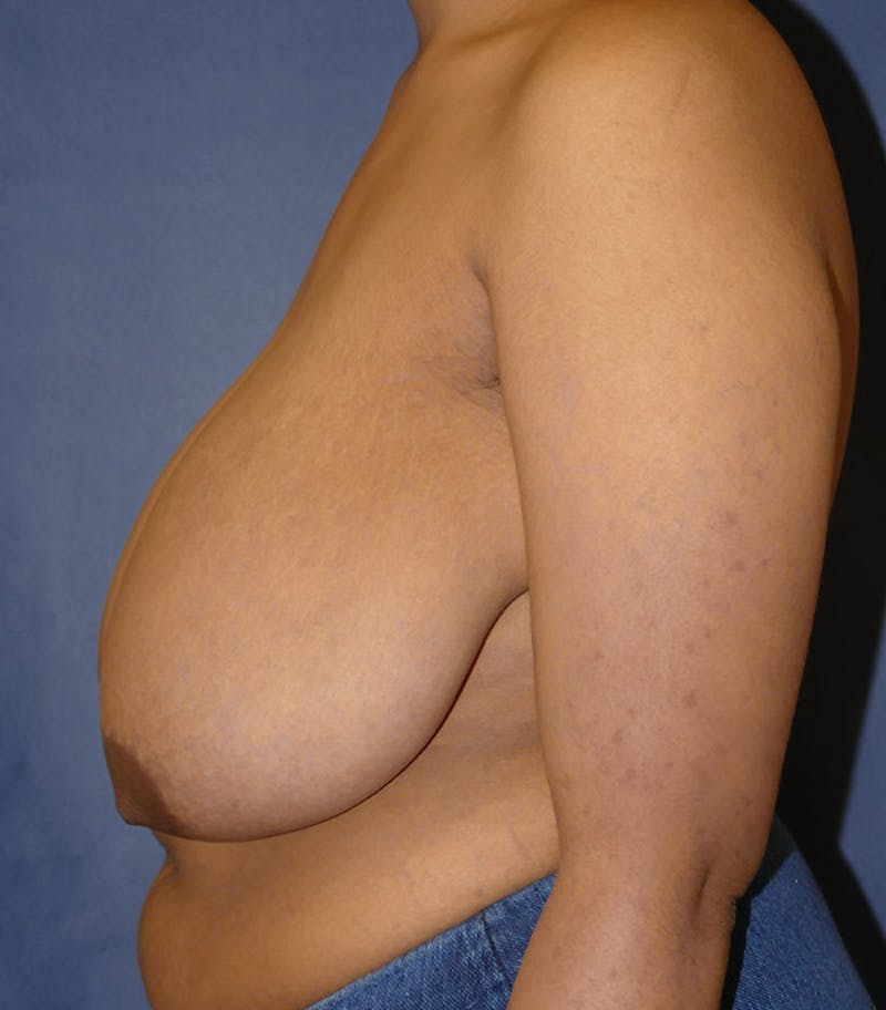 Breast Reduction Before & After Gallery - Patient 681288 - Image 3
