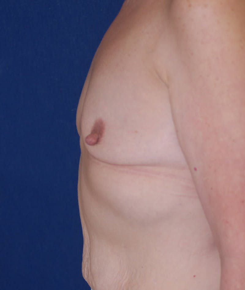 Breast Augmentation Before & After Gallery - Patient 107856 - Image 9