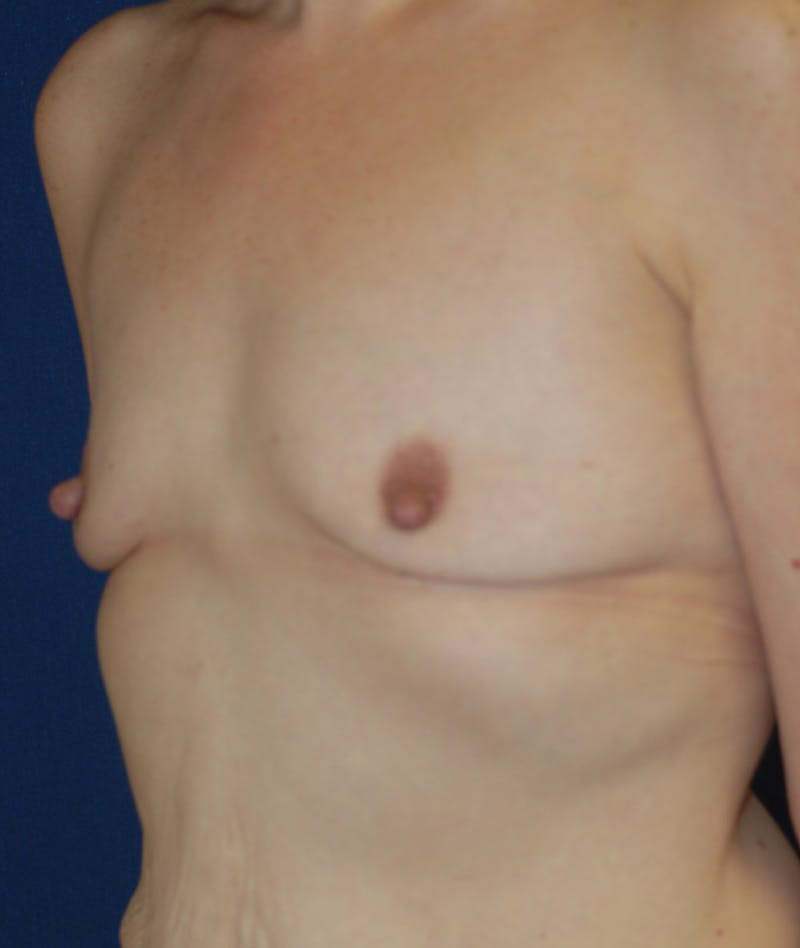 Breast Augmentation Before & After Gallery - Patient 107856 - Image 7