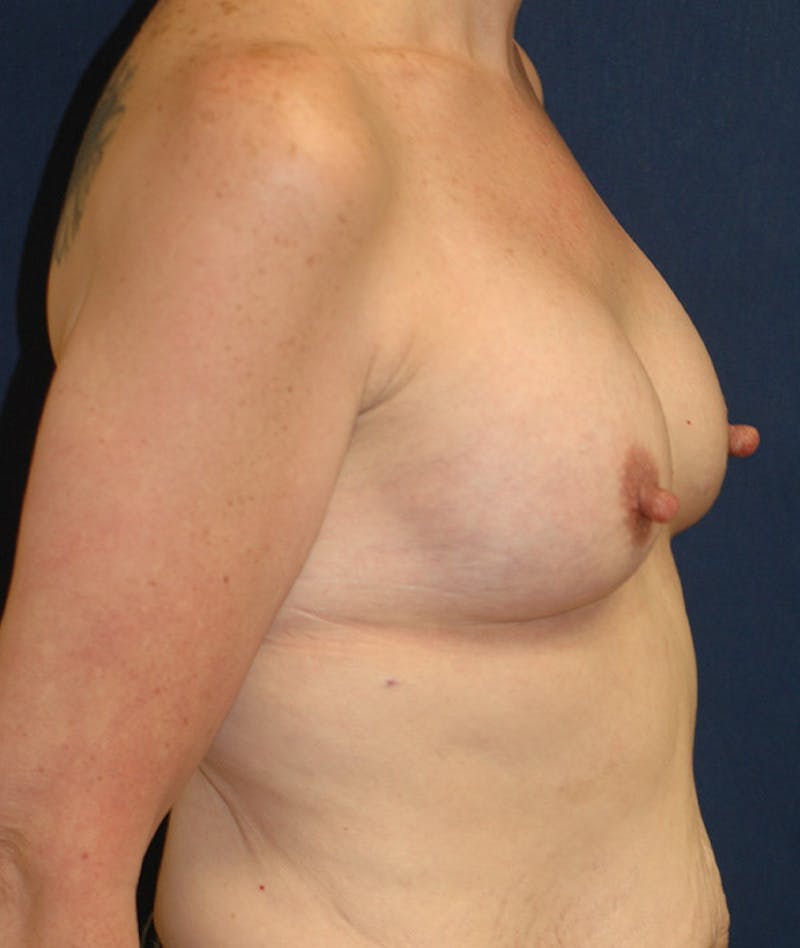 Breast Augmentation Before & After Gallery - Patient 107856 - Image 4