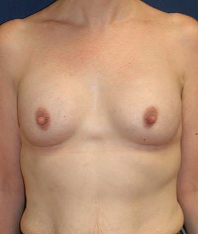 Breast Augmentation Before & After Gallery - Patient 107856 - Image 2