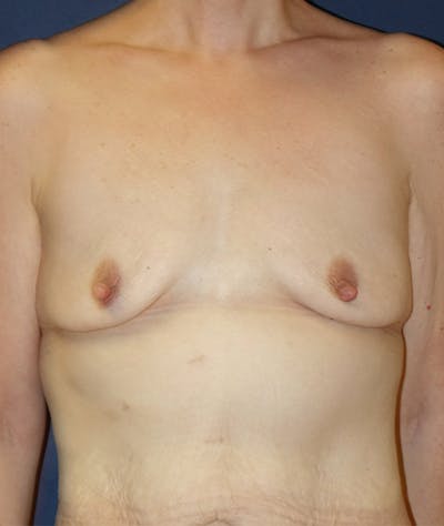 Breast Augmentation Before & After Gallery - Patient 107856 - Image 1