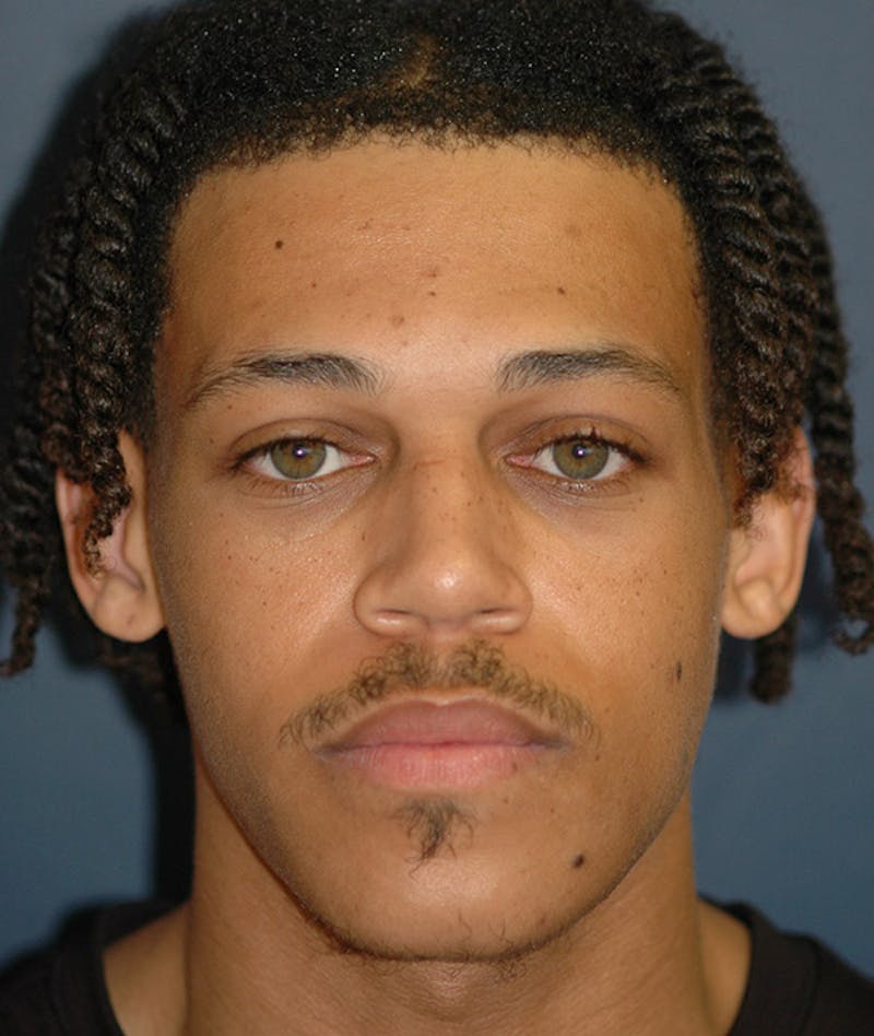 Jaw Implants Before & After Gallery - Patient 501670 - Image 1