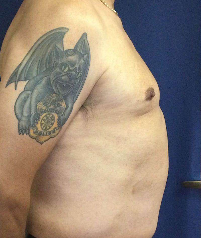 Pectoral Implants Before & After Gallery - Patient 351636 - Image 9