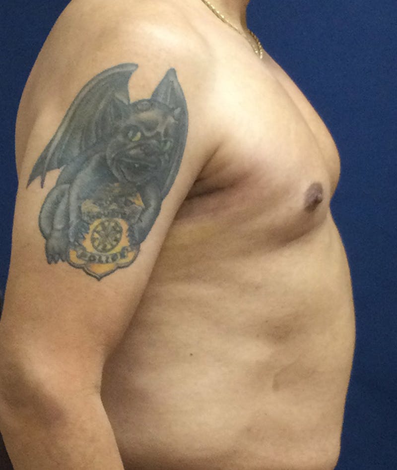 Pectoral Implants Before & After Gallery - Patient 351636 - Image 10