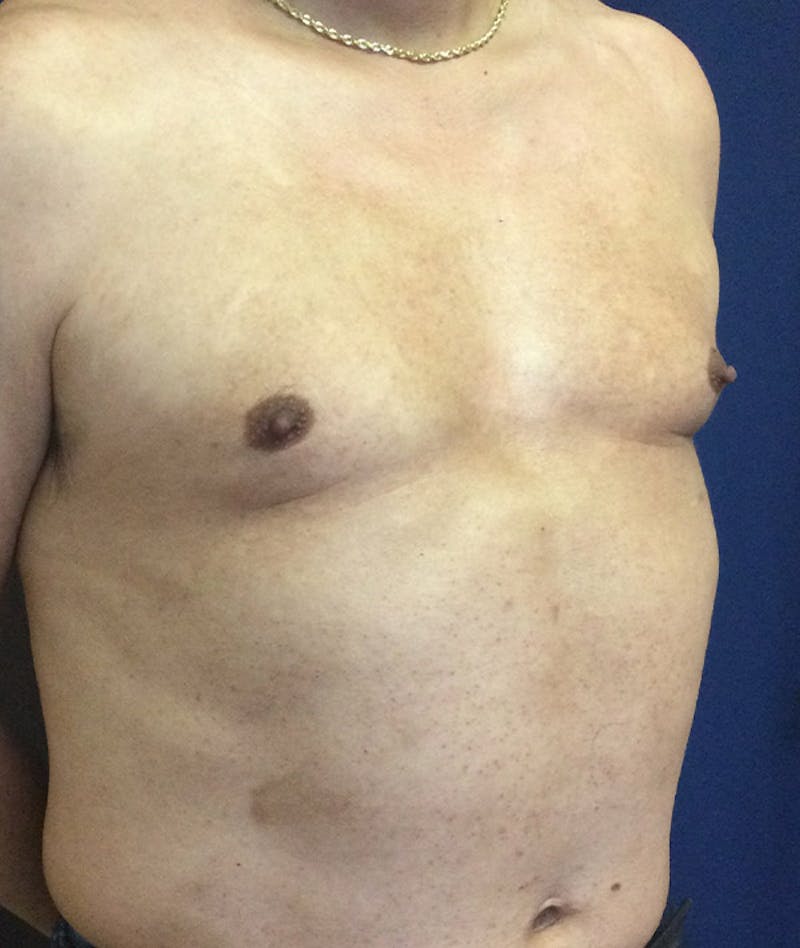 Pectoral Implants Before & After Gallery - Patient 351636 - Image 7