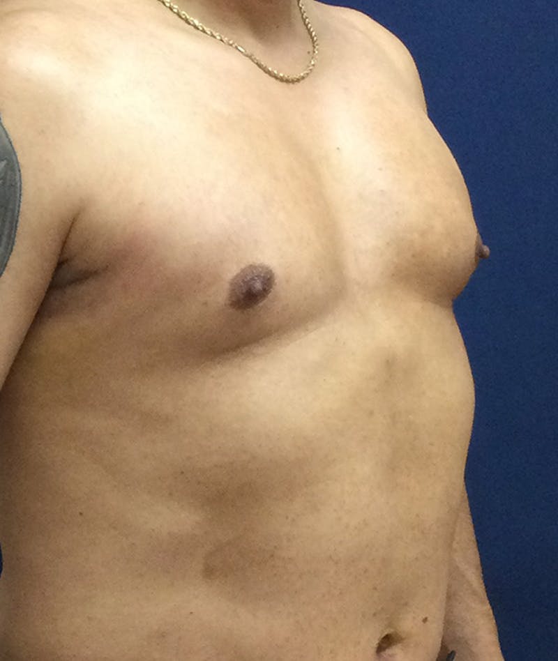 Pectoral Implants Before & After Gallery - Patient 351636 - Image 8