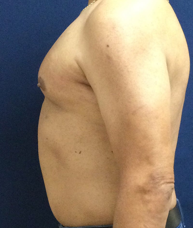 Pectoral Implants Before & After Gallery - Patient 351636 - Image 6
