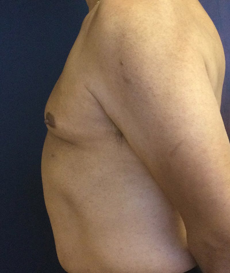 Pectoral Implants Before & After Gallery - Patient 351636 - Image 5