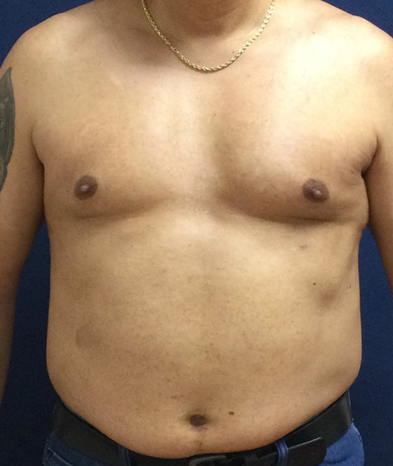 Pectoral Implants Before & After Gallery - Patient 351636 - Image 2