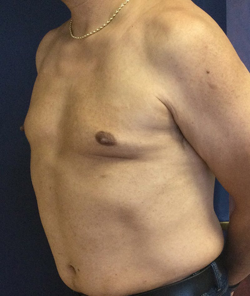 Pectoral Implants Before & After Gallery - Patient 351636 - Image 3
