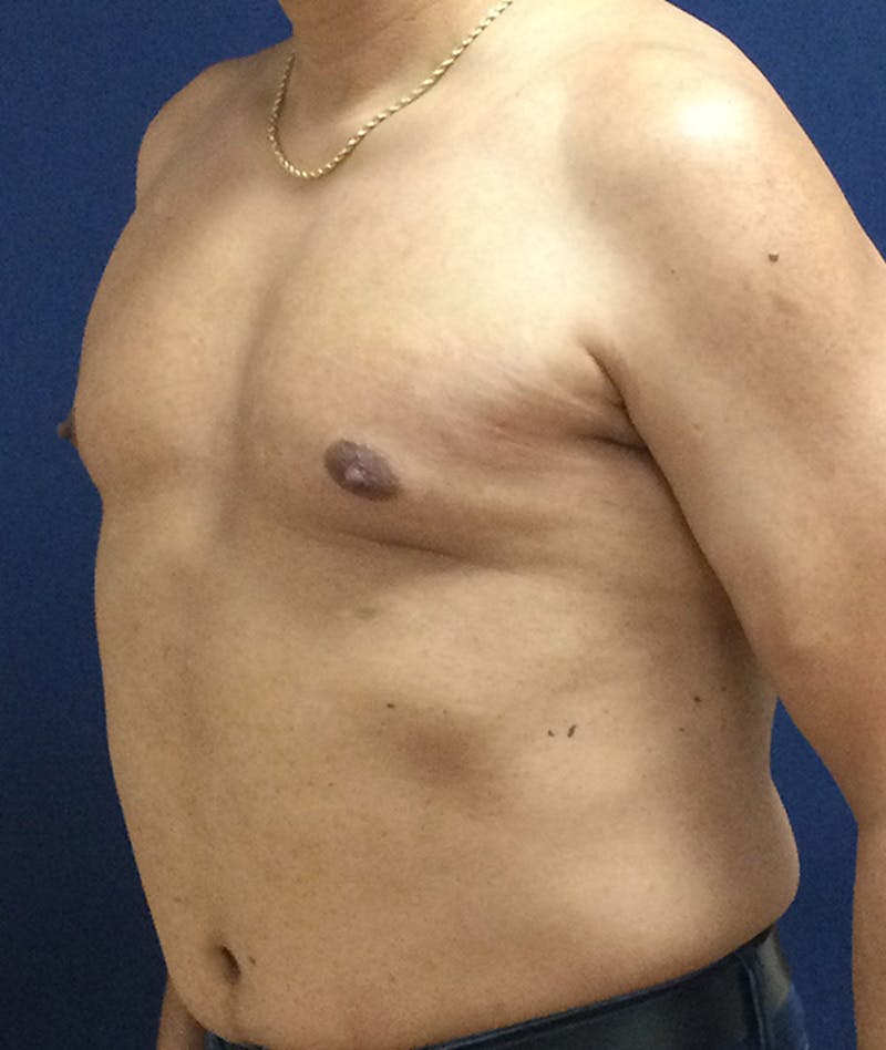 Pectoral Implants Before & After Gallery - Patient 351636 - Image 4