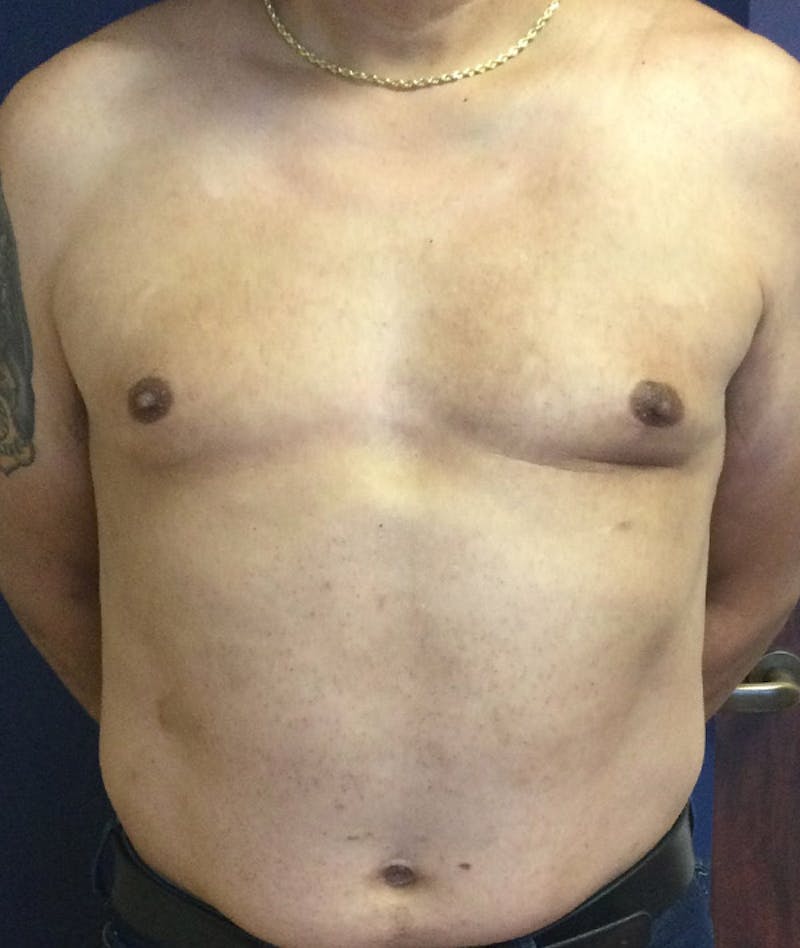 Pectoral Implants Before & After Gallery - Patient 351636 - Image 1
