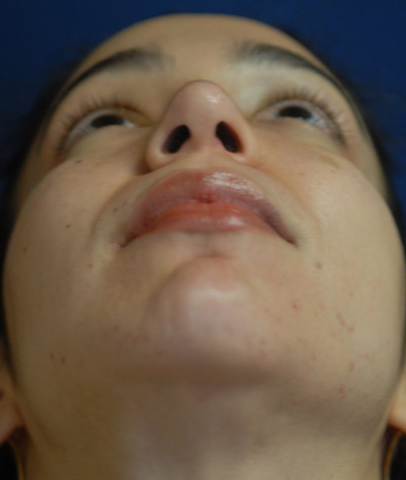 Chin Augmentation Before & After Gallery - Patient 304379 - Image 14