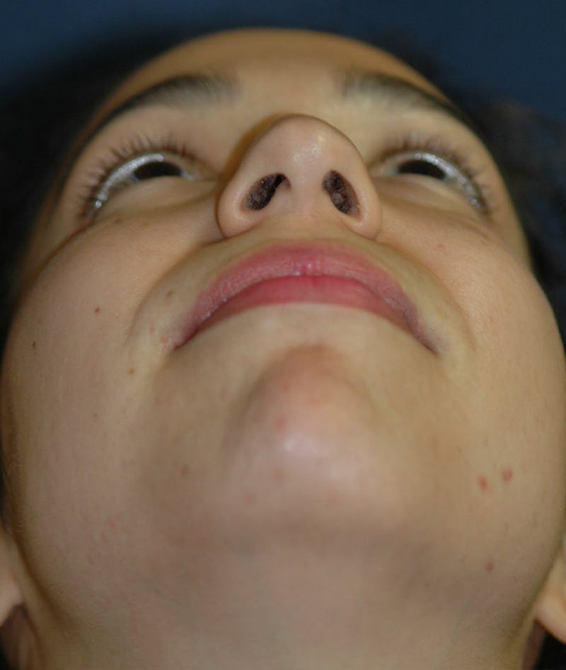 Chin Augmentation Before & After Gallery - Patient 304379 - Image 13