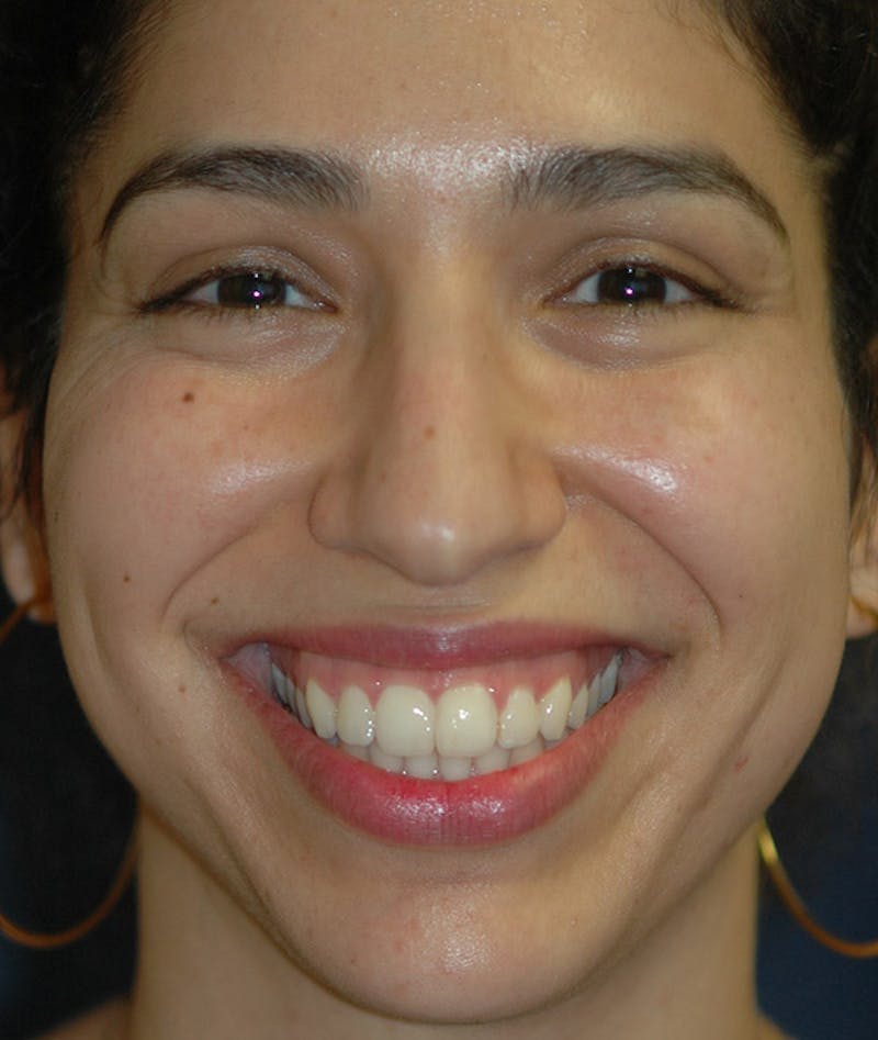 Chin Augmentation Before & After Gallery - Patient 304379 - Image 11