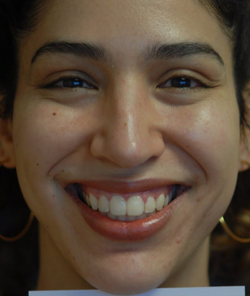 Chin Augmentation Before & After Gallery - Patient 304379 - Image 12