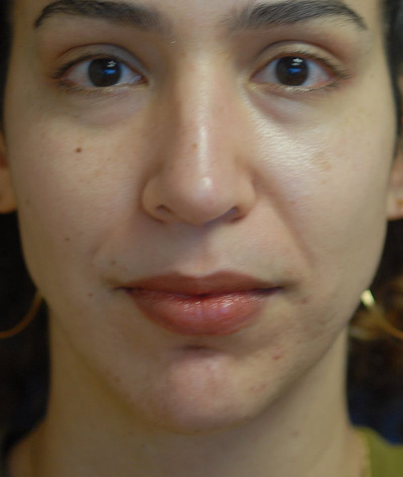 Chin Augmentation Before & After Gallery - Patient 304379 - Image 10