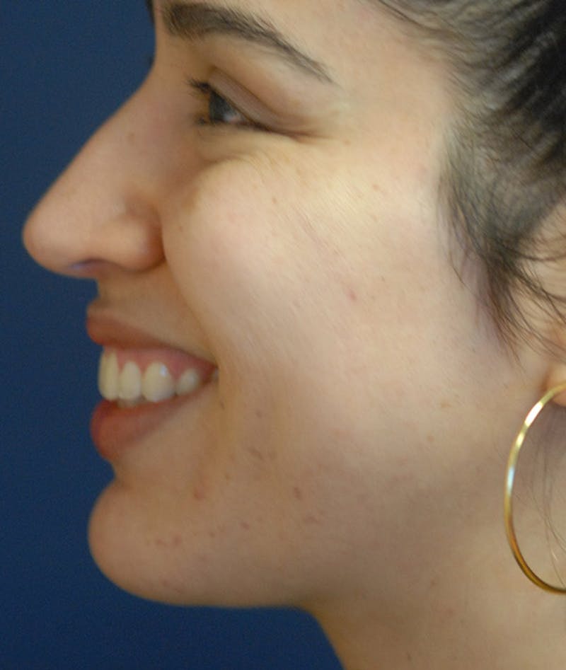 Chin Augmentation Before & After Gallery - Patient 304379 - Image 8