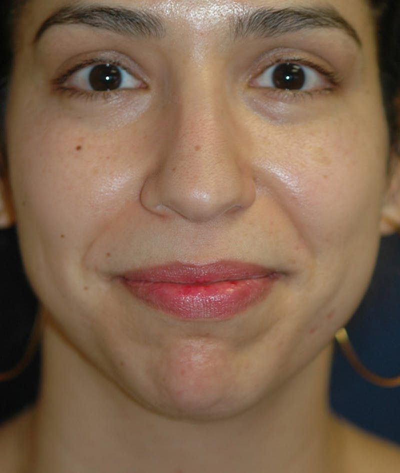 Chin Augmentation Before & After Gallery - Patient 304379 - Image 9