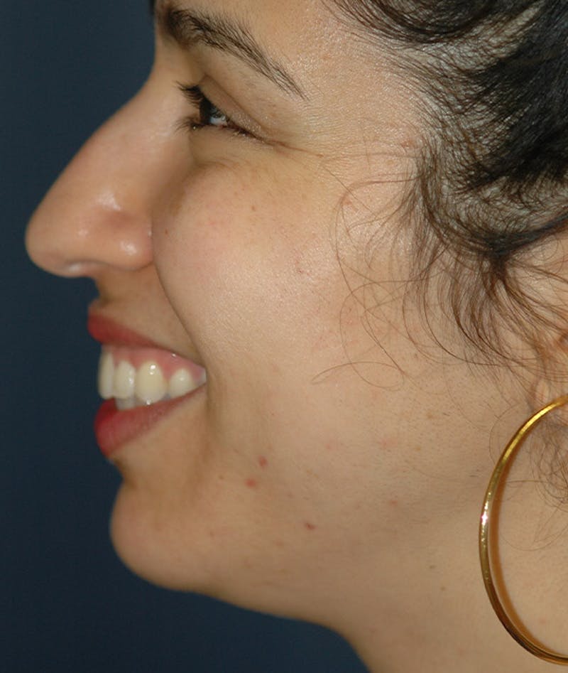 Chin Augmentation Before & After Gallery - Patient 304379 - Image 7