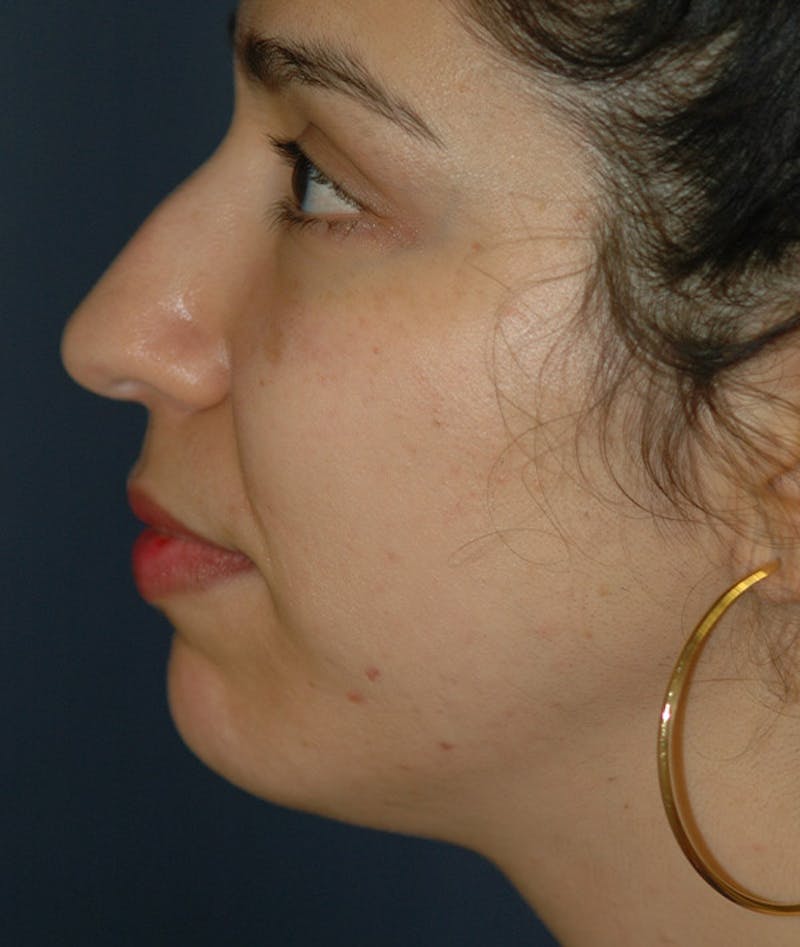 Chin Augmentation Before & After Gallery - Patient 304379 - Image 5