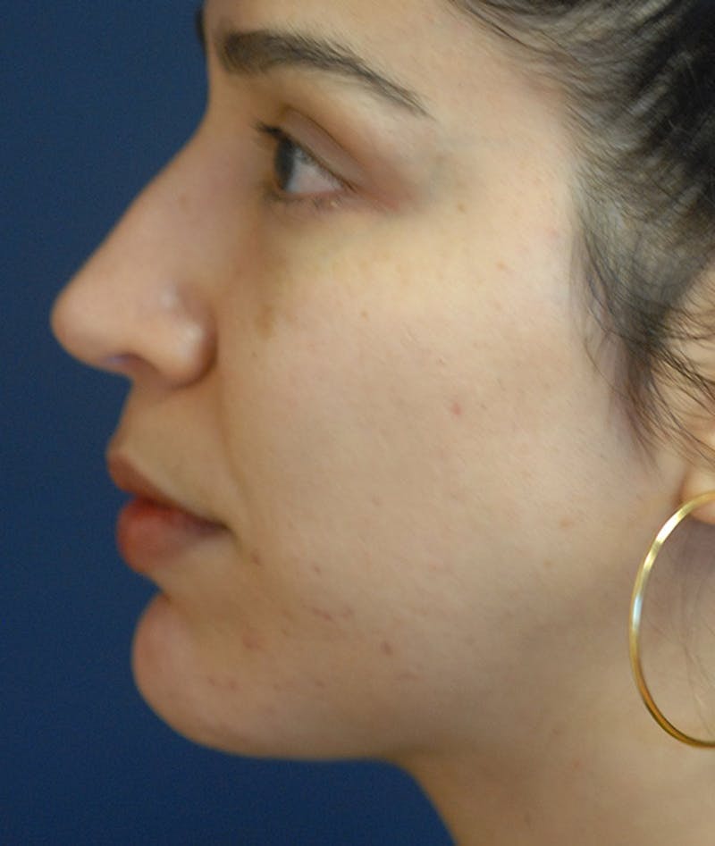 Chin Augmentation Before & After Gallery - Patient 304379 - Image 6
