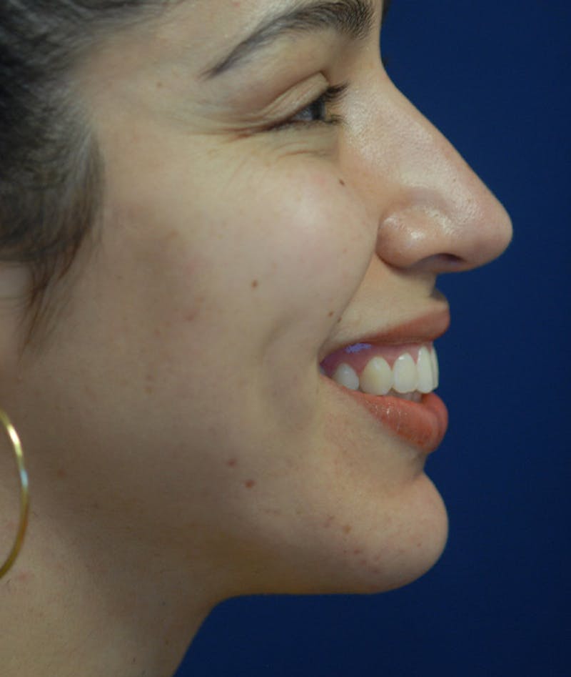 Chin Augmentation Before & After Gallery - Patient 304379 - Image 4