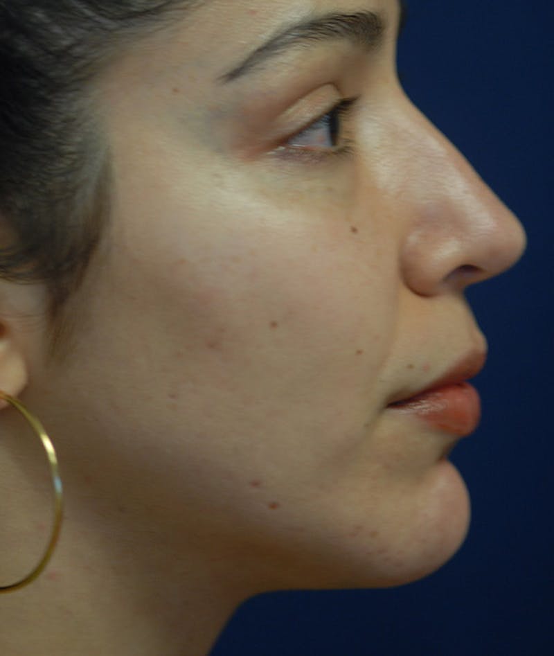 Chin Augmentation Before & After Gallery - Patient 304379 - Image 2