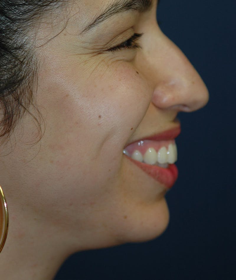 Chin Augmentation Before & After Gallery - Patient 304379 - Image 3