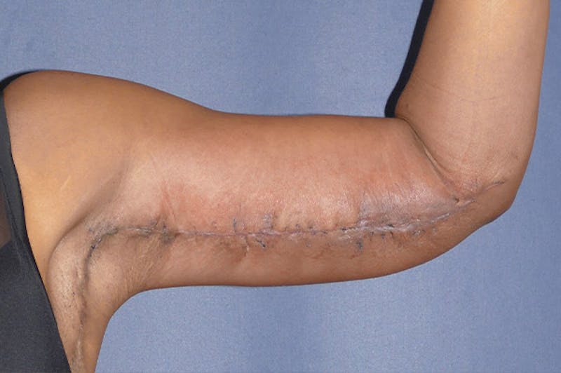 Arm Lift (Brachioplasty) Before & After Gallery - Patient 137473 - Image 8