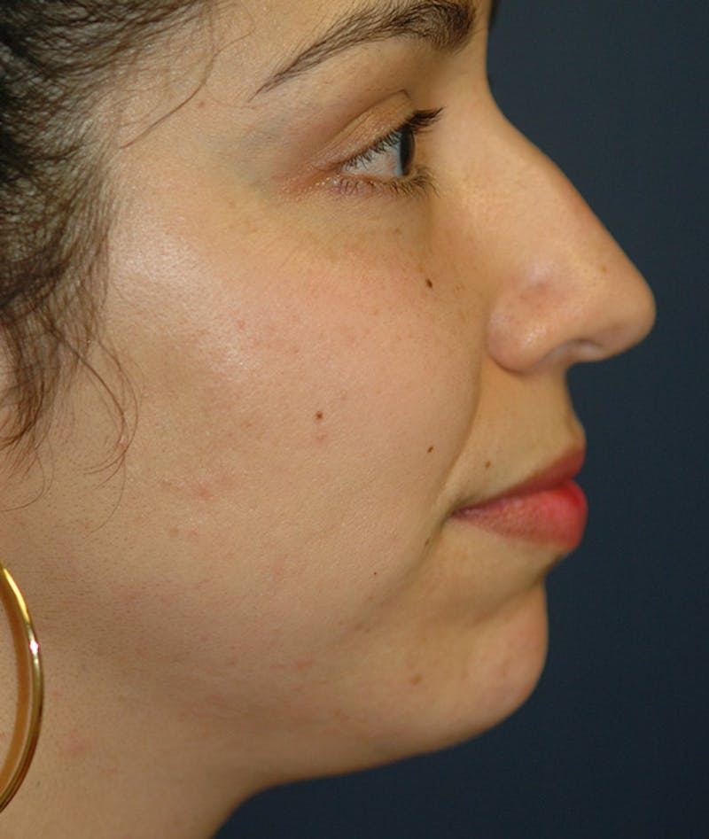 Chin Augmentation Before & After Gallery - Patient 304379 - Image 1