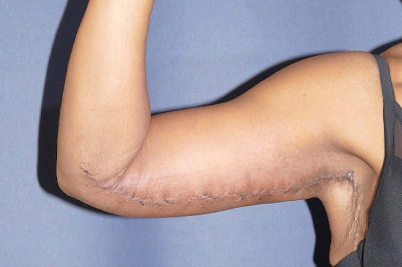 Arm Lift (Brachioplasty) Before & After Gallery - Patient 137473 - Image 6