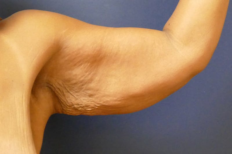 Arm Lift (Brachioplasty) Before & After Gallery - Patient 137473 - Image 7