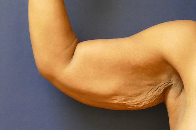 Arm Lift (Brachioplasty) Before & After Gallery - Patient 137473 - Image 5