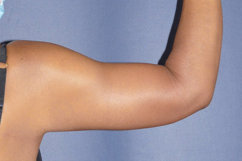 Arm Lift (Brachioplasty) Before & After Gallery - Patient 137473 - Image 4
