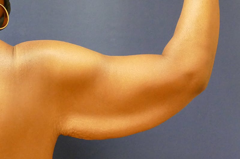 Arm Lift (Brachioplasty) Before & After Gallery - Patient 137473 - Image 3