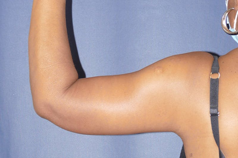 Arm Lift (Brachioplasty) Before & After Gallery - Patient 137473 - Image 2