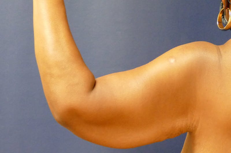 Arm Lift (Brachioplasty) Before & After Gallery - Patient 137473 - Image 1