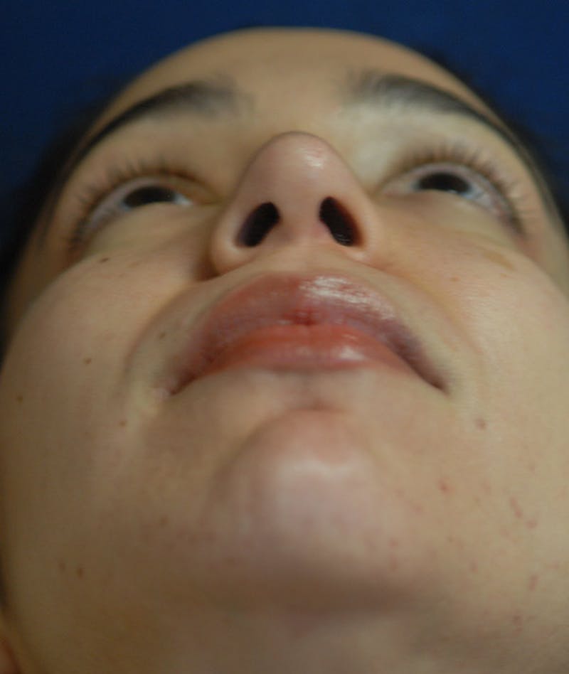Rhinoplasty Before & After Gallery - Patient 234570 - Image 14